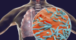 Enfermedades no erradicadas: Tuberculosis. Estado actual en el mundo y en la región de las Américas, y estrategia mundial para abordarlas