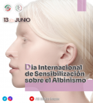 13 de junio – Día Internacional de Sensibilización sobre el Albinismo 